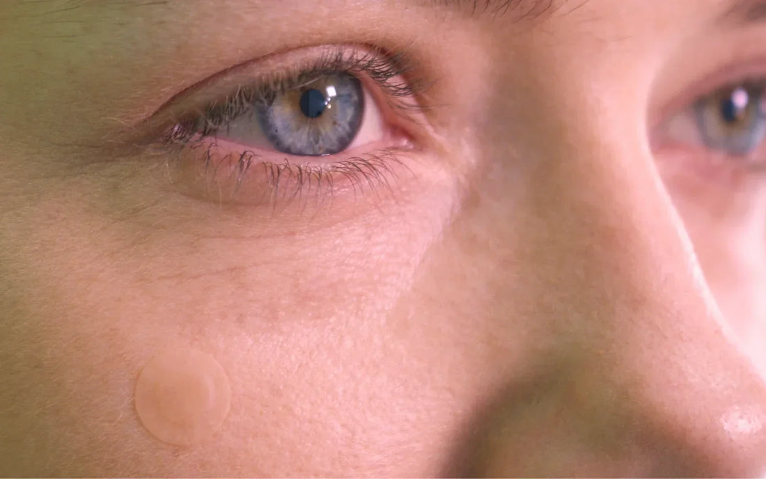 Adult Acne Still Happens: The Discreet Pimple Patch for Hormonal Breakouts