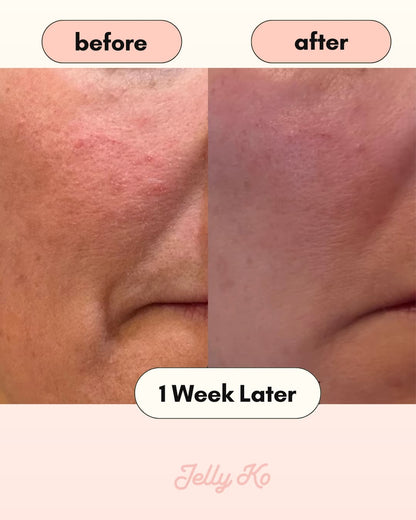 Before and After Results with Jelly Ko